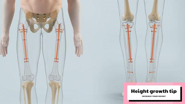 leg lengthening surgery